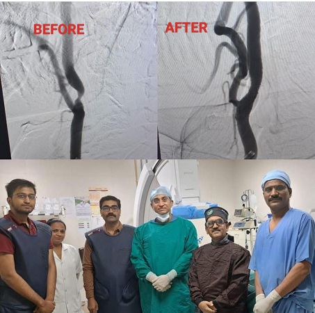 Carotid Angioplasty Pic