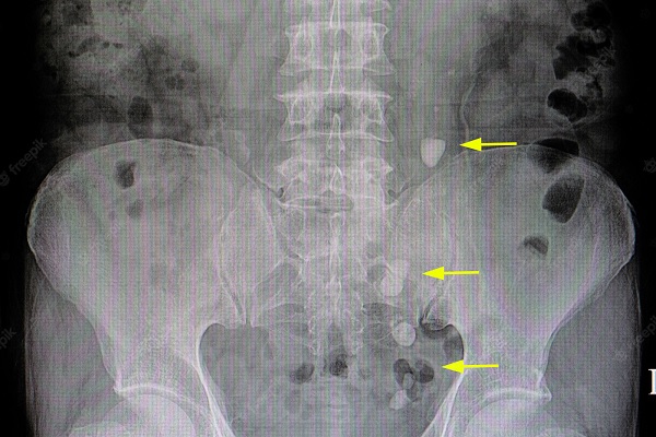 Ureteric Stone X-Ray